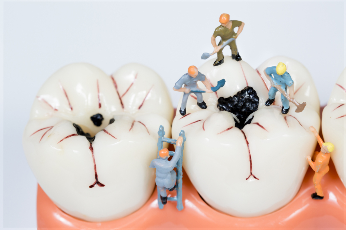 虫歯を治療しているイメージ