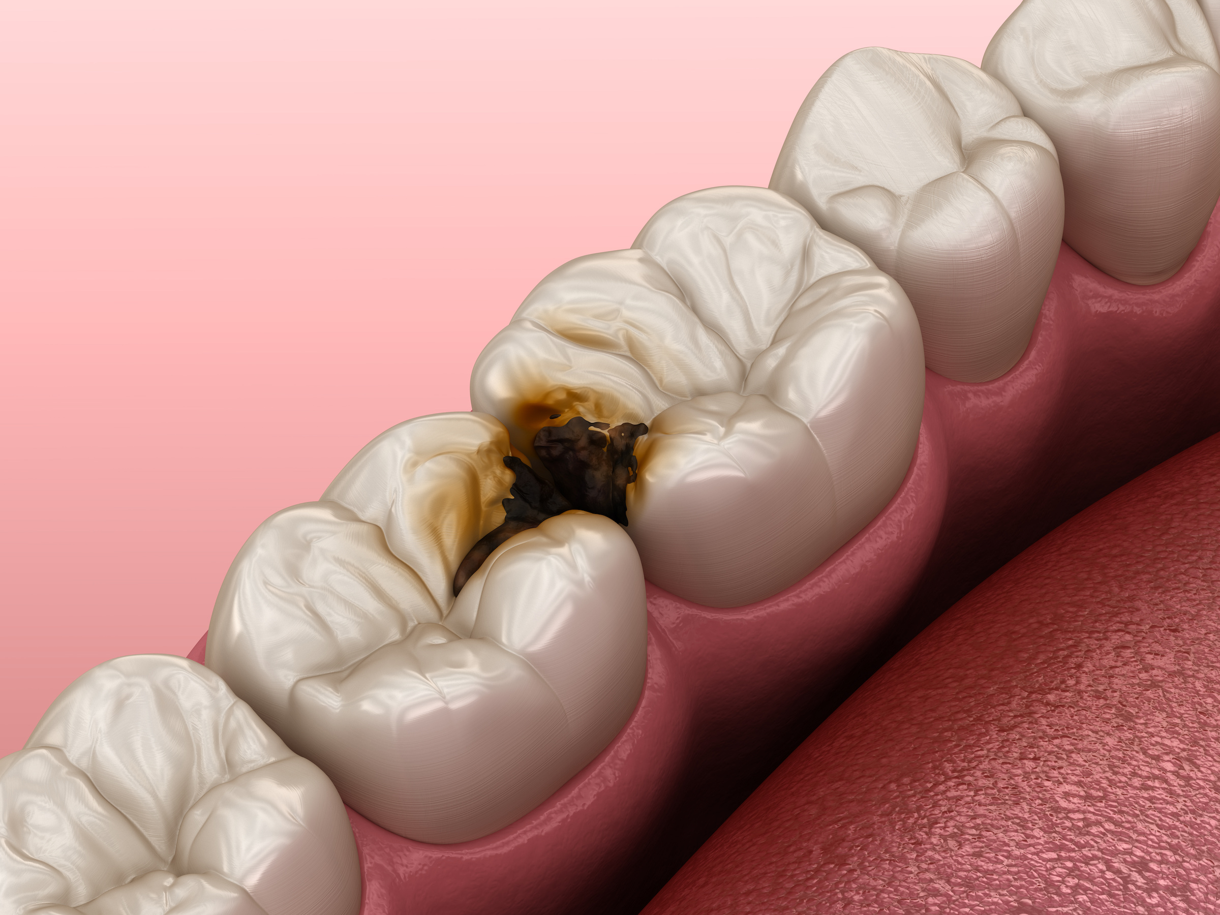 歯の間の虫歯