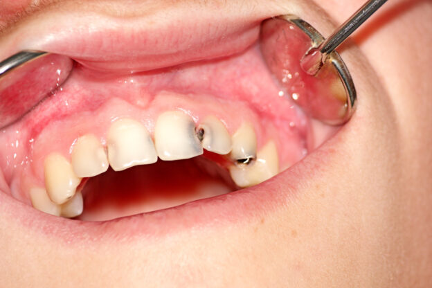 歯の間の虫歯