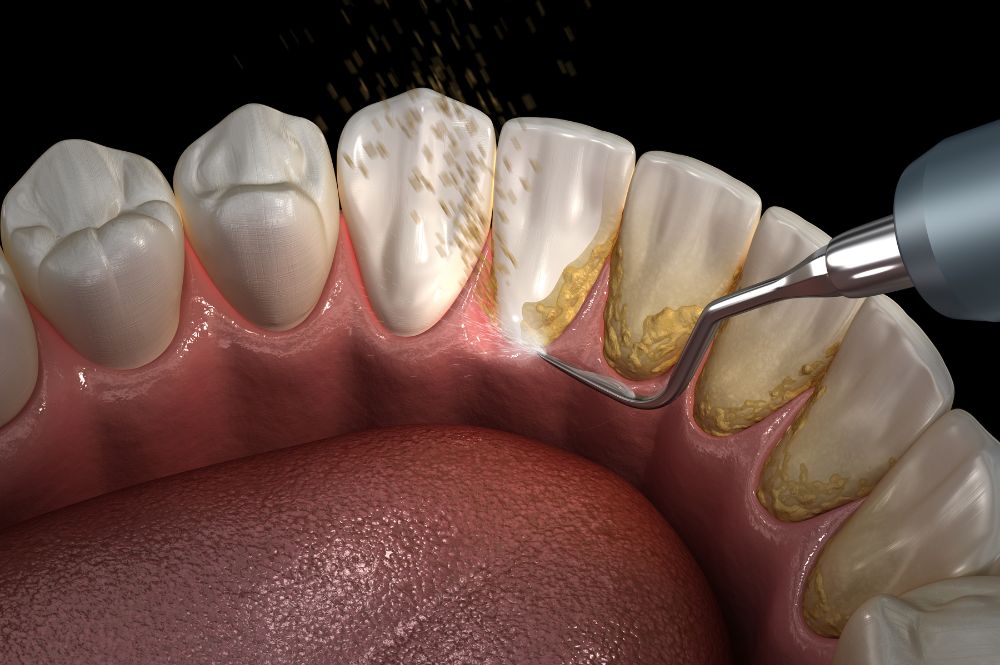 歯のクリーニングのイメージ